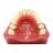 Arc Transpalatin Mesial