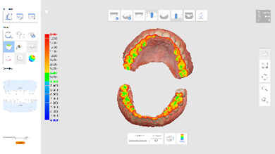 schema analyse d'occlusion