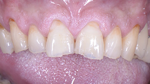Modelage direct cas 1