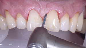 Modelage direct cas 2