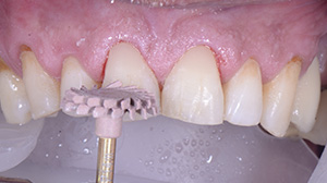 Modelage direct cas 1