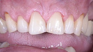 Modelage direct cas 1