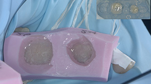 Modelage direct cas 1