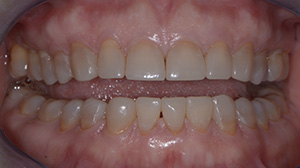 Modelage direct cas 1