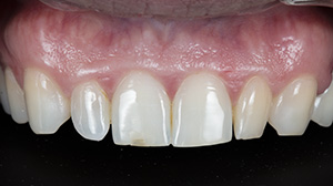 Abrasion dentaire