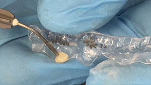 Traitement orthodontique préalable