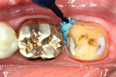 clinical-case-astringent-retraction-paste-surrounding-tooth