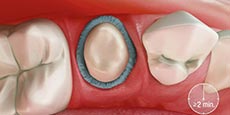 illustration-of-astringent-retraction-paste-around-tooth