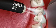 illustration-of-water-air-being-sprayed-on-tooth