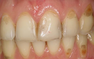 Zones cervicales