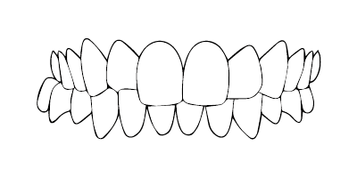 Occlusion croisée