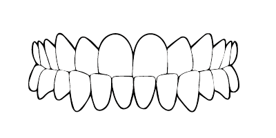Proalvéolie / Rétroalvéolie