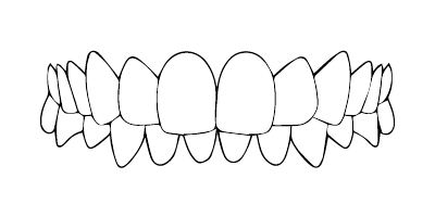 Supraclusion / Sousocclusion